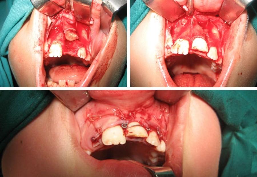 Διαφυγή δοντιού στη μύτη μετά από κάταγμα και επαναφορά του στη γνάθο με παράλληλη διάσωσή του στην αρχική θέση